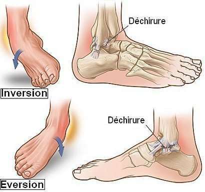 Comment Soigner Une Entorse De Cheville Blog