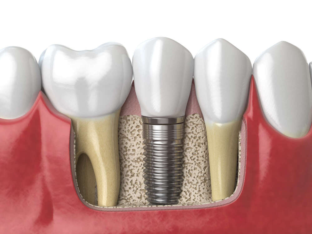 L’implantologie dentaire : une solution fiable pour remplacer les dents manquantes