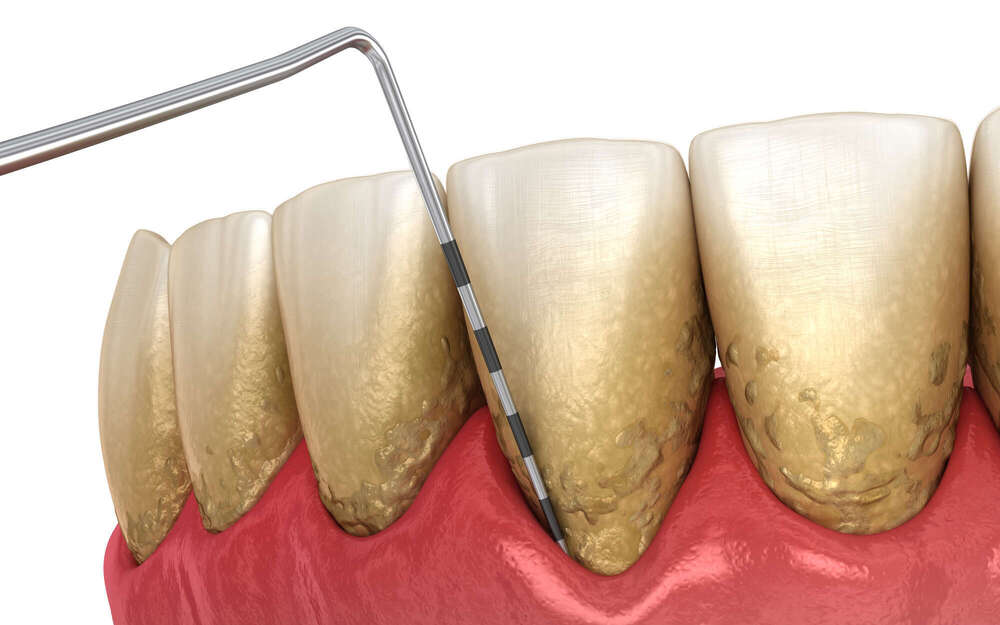 La parodontologie : préserver les tissus de soutien des dents