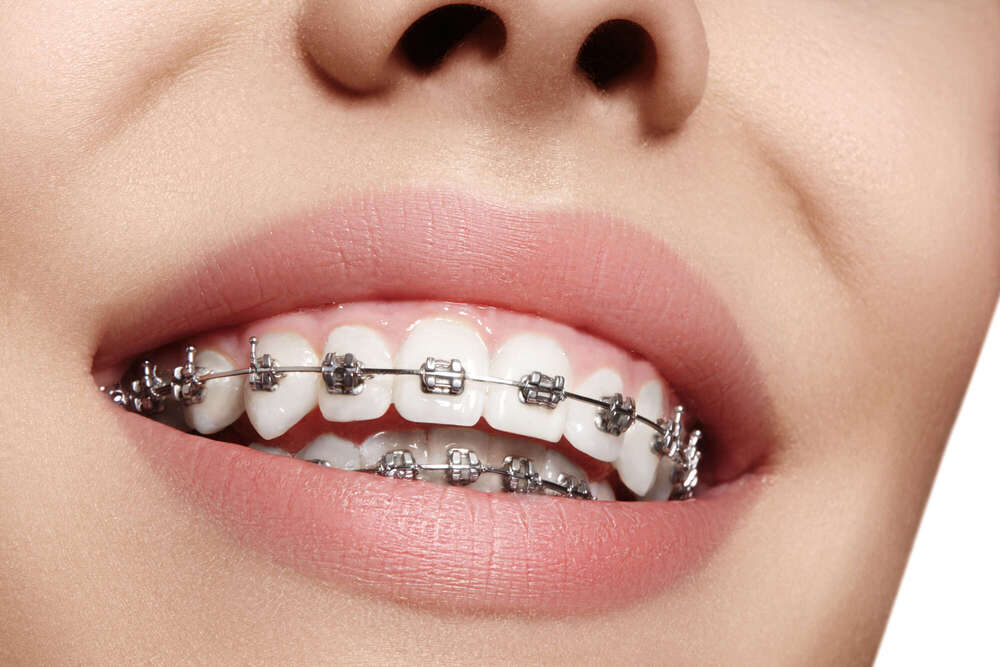 L’orthodontie : corriger les malpositions dentaires et fonctionnelles