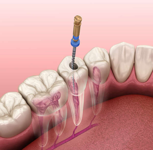 L’endodontie : traiter les infections internes pour sauver la dent - La maison dentaire