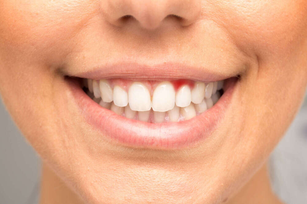 La parodontologie : préserver les tissus de soutien des dents - La maison dentaire