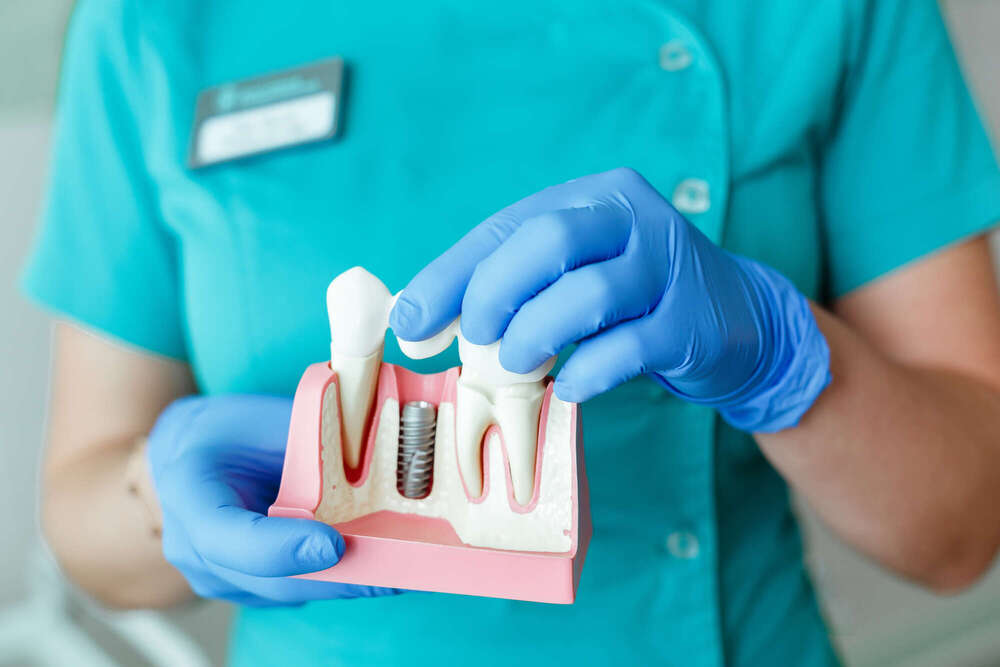 Préserver ses gencives pour garantir la réussite des implants dentaires - La maison dentaire