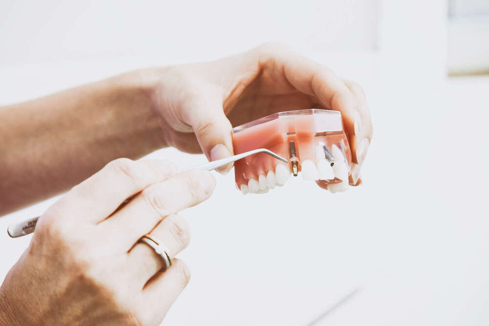 Entretenir ses implants dentaires pour une santé durable - La maison dentaire