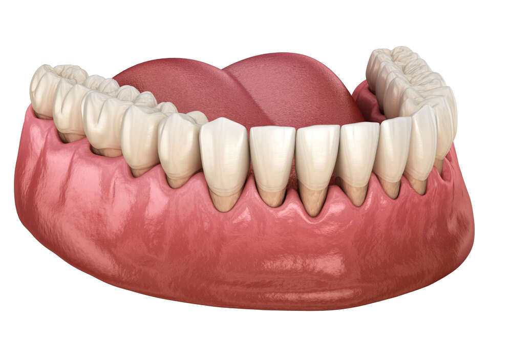 Prévenir les maladies parodontales et préparer les tissus avant la pose d’un implant - La maison dentaire
