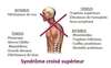 schéma syndrome croisé supérieur