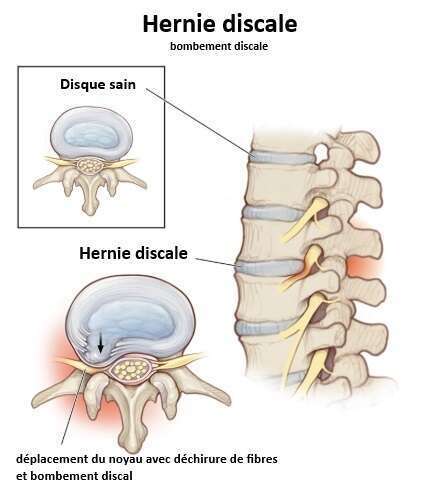 Hernie discale, discopathie, sciatique, cruralgie et névralgie cervico-brachiale : comment la chiropraxie peut-elle vous aider ?