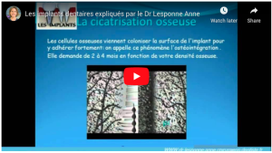 Les implants dentaires expliqués par le Dr Lesponne Anne