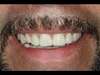 Bruxisme couronne - Après 2