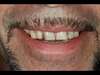 Bruxisme couronne - Après 1