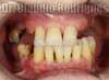 Implant complet - Avant