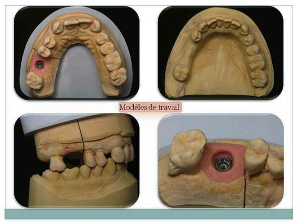 APPORT DE LA CFAO EN IMPLANTOLOGIE