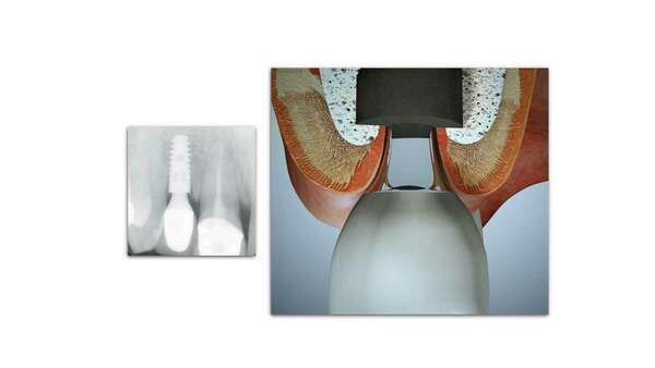 TECHNIQUES DE POSE CONVENTIONNELLES POUR LES IMPLANTS