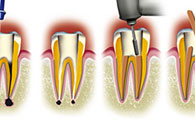 LE RETRAITEMENT ENDODONTIQUE