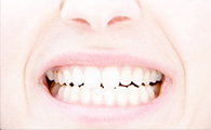 LES GRINCEMENTS DE DENTS : LE BRUXISME
