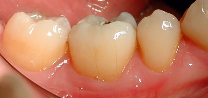 DENTISTERIE ESTHÉTIQUE : FÊLURE ET FRACTURE DENTAIRE : STADE 3