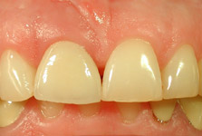 DENTISTERIE ESTHÉTIQUE : FÊLURE ET FRACTURE DENTAIRE : STADE 4