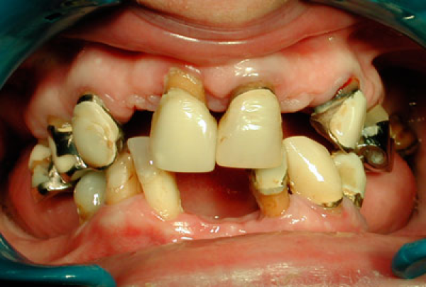DENTISTERIE ESTHÉTIQUE : RÉHABILITATION TRADITIONNELLE NON IMPLANTAIRE
