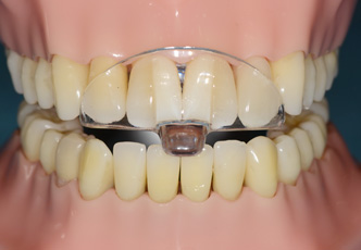 DENTISTERIE ESTHÉTIQUE : GESTION ESTHÉTIQUE DE L'USURE DENTAIRE GÉNÉRALISÉE