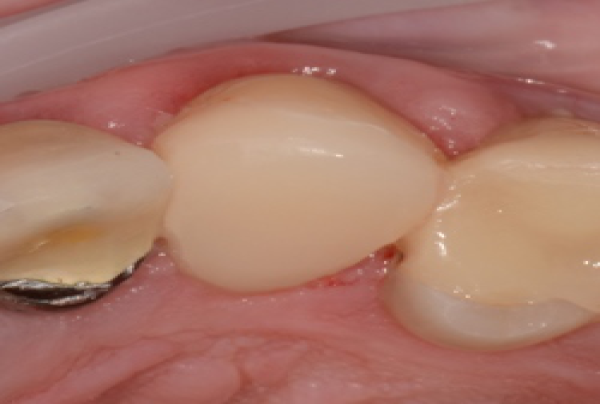 DENTISTERIE ESTHÉTIQUE : GESTION ESTHÉTIQUE ET NON DÉLABRANTE D'UNE USURE DENTAIRE LOCALISÉE