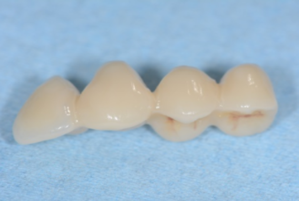 DENTISTERIE ESTHÉTIQUE : LES COURONNES JUMELÉES ET LES BRIDGES DE CONTENTION