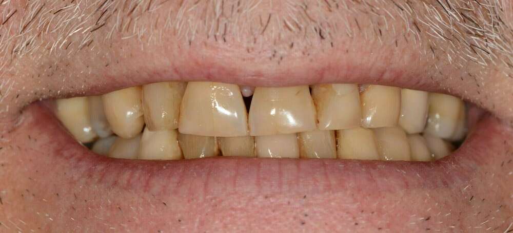 LES PETITS TRIANGLES NOIRS ENTRE LES DENTS : CE QU'IL FAUT SAVOIR
