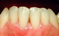 PARODONTOLOGIE: LES GREFFES GINGIVALES