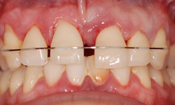 PARODONTOLOGIE: COMBINAISON AVEC L'ORTHODONTIE