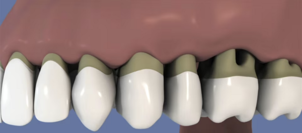 Brossette interdentaire et parodontite