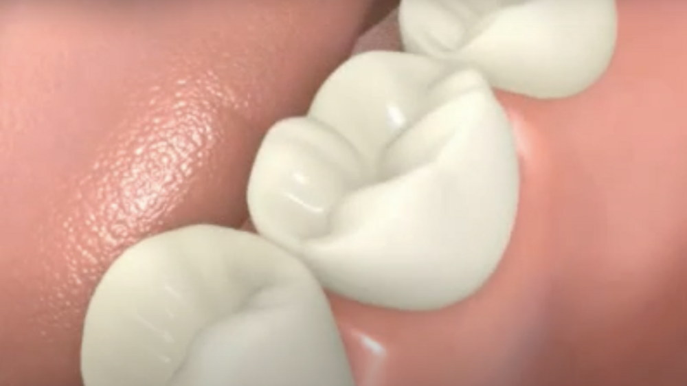 Couronne sur implant dentaire