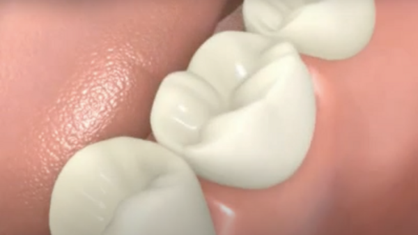 Couronne sur implant dentaire