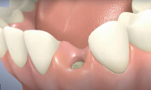 Pose d'un implant dentaire en 2 temps avec un pilier titane
