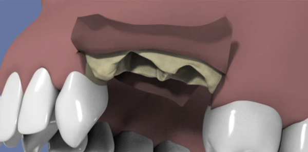 Extraction et comblement osseux