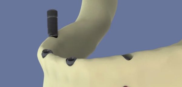 Mandibule : All on four