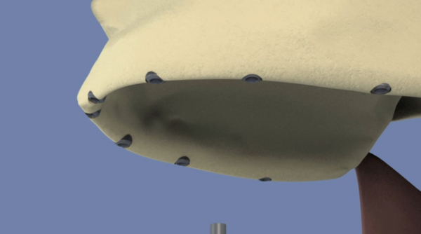 Maxillaire 8 implants et comblement de sinus 