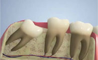 LES EXTRACTIONS DENTAIRES