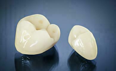POURQUOI FAUT-IL REMPLACER UNE DENT MANQUANTE ?