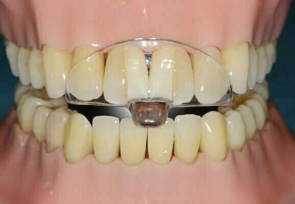 IMPLANTOLOGIE : PRÉVENTION DU BRUXISME