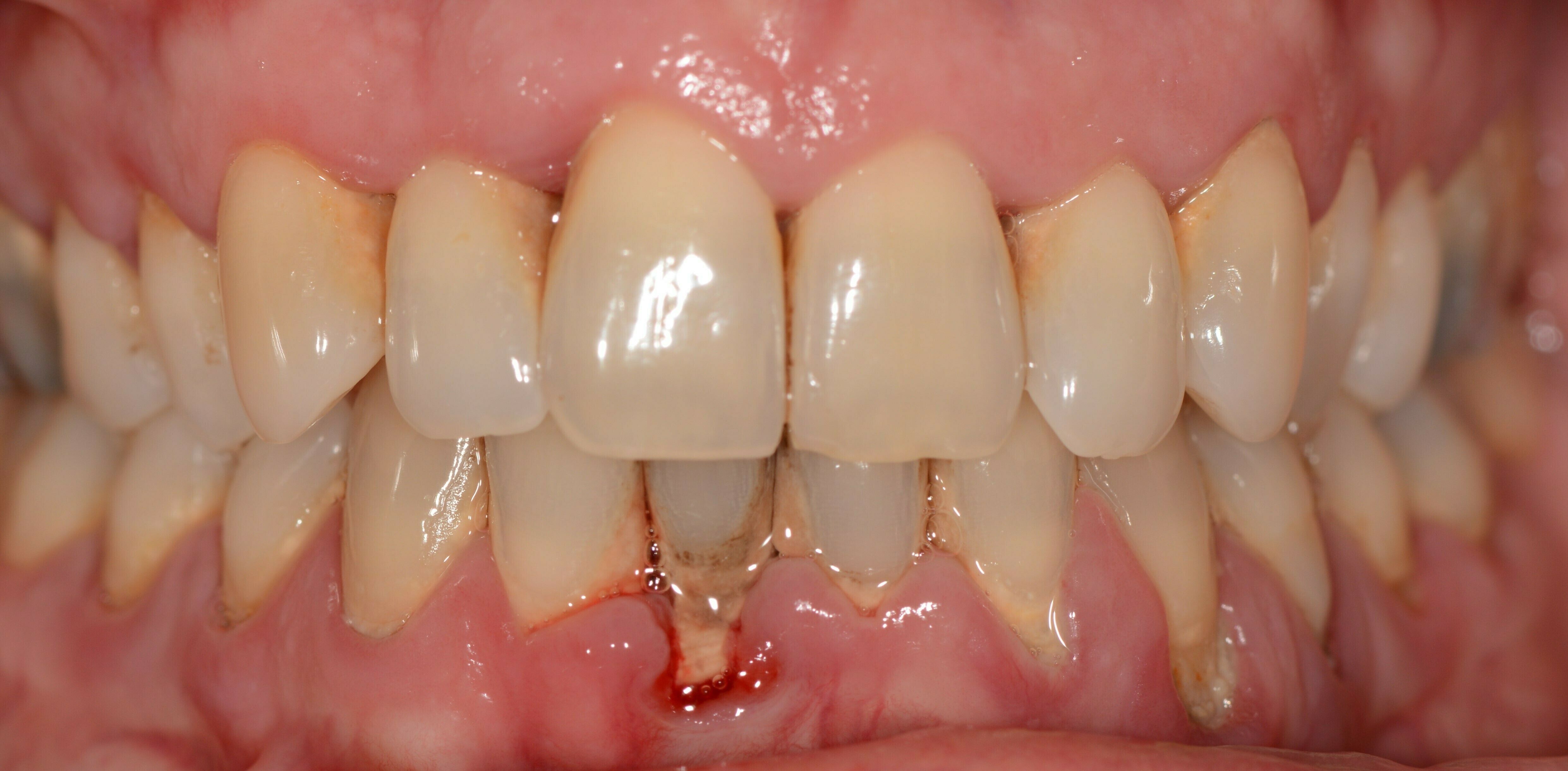 Sonde Parodontale Williams Professionnelle - Acier Inoxydable - Pour Mesure De Profondeur De Poche - Neuf