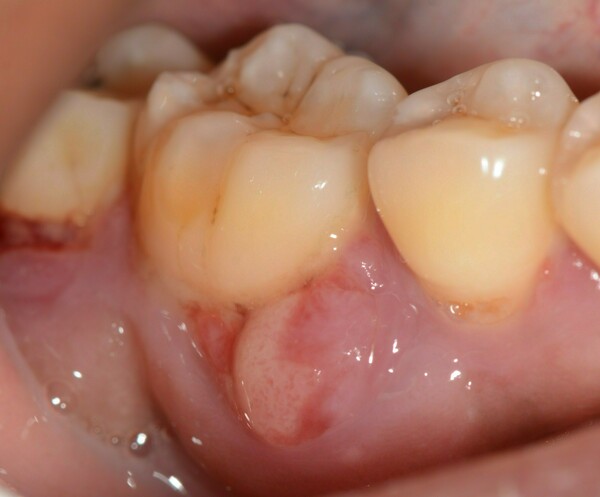 PARODONTOLOGIE : LES URGENCES EN PARODONTOLOGIE