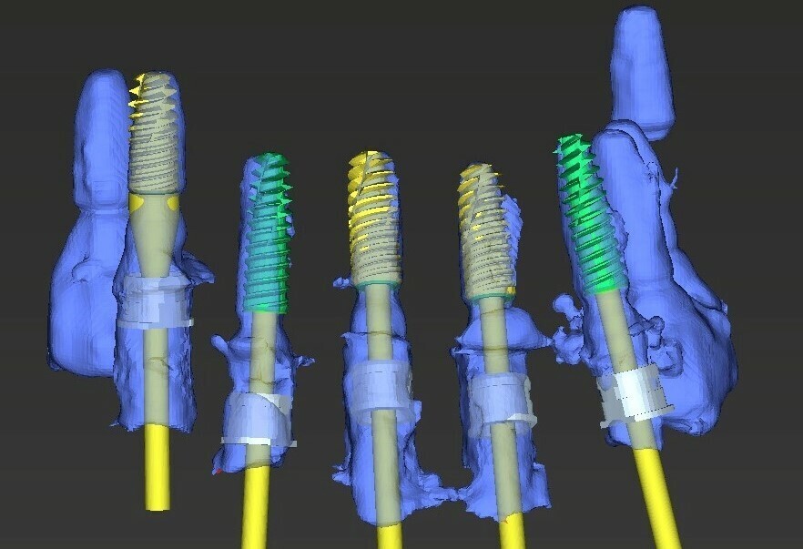 IMPLANTOLOGIE : LA CHIRUGIE GUIDEE