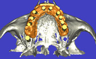 IMPLANTOLOGIE: LA SIMULATION IMPLANTAIRE POUR UN GUIDAGE CHIRURGICAL OPTIMAL