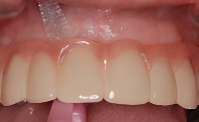 IMPLANTOLOGIE: IMPORTANCE DE L'HYGIÈNE INTER-IMPLANTAIRE PERSONNELLE ET QUOTIDIENNE