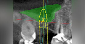 IMPLANTOLOGIE: LE COMBLEMENT SINUSIEN MAXILLAIRE