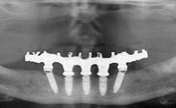 IMPLANTOLOGIE: L'USINAGE DES ARMATURES TITANE ET ZIRCONE DES SYSTÈMES PROCERA ET SIMEDA