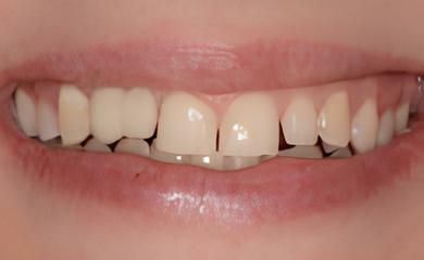 IMPLANTOLOGIE : CAS ESTHÉTIQUES COMPLEXES