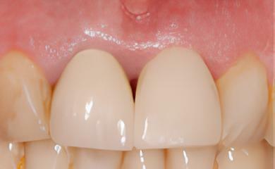 IMPLANTOLOGIE: EXTRACTION-IMPLANTATION IMMÉDIATE