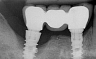IMPLANTOLOGIE : LA PÉRI-IMPLANTITE, COMPLICATION CLASSIQUE À TRAITER SANS TARDER