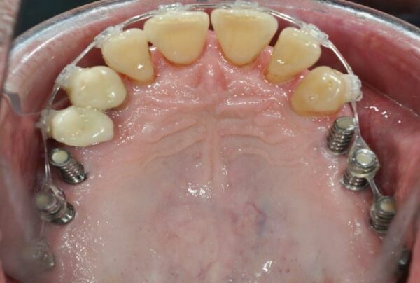 IMPLANTOLOGIE : CAS COMBINÉS AVEC L'ORTHODONTIE