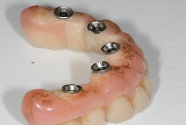 IMPLANTOLOGIE: MAINTENANCE IMPLANTAIRE PROFESSIONNELLE